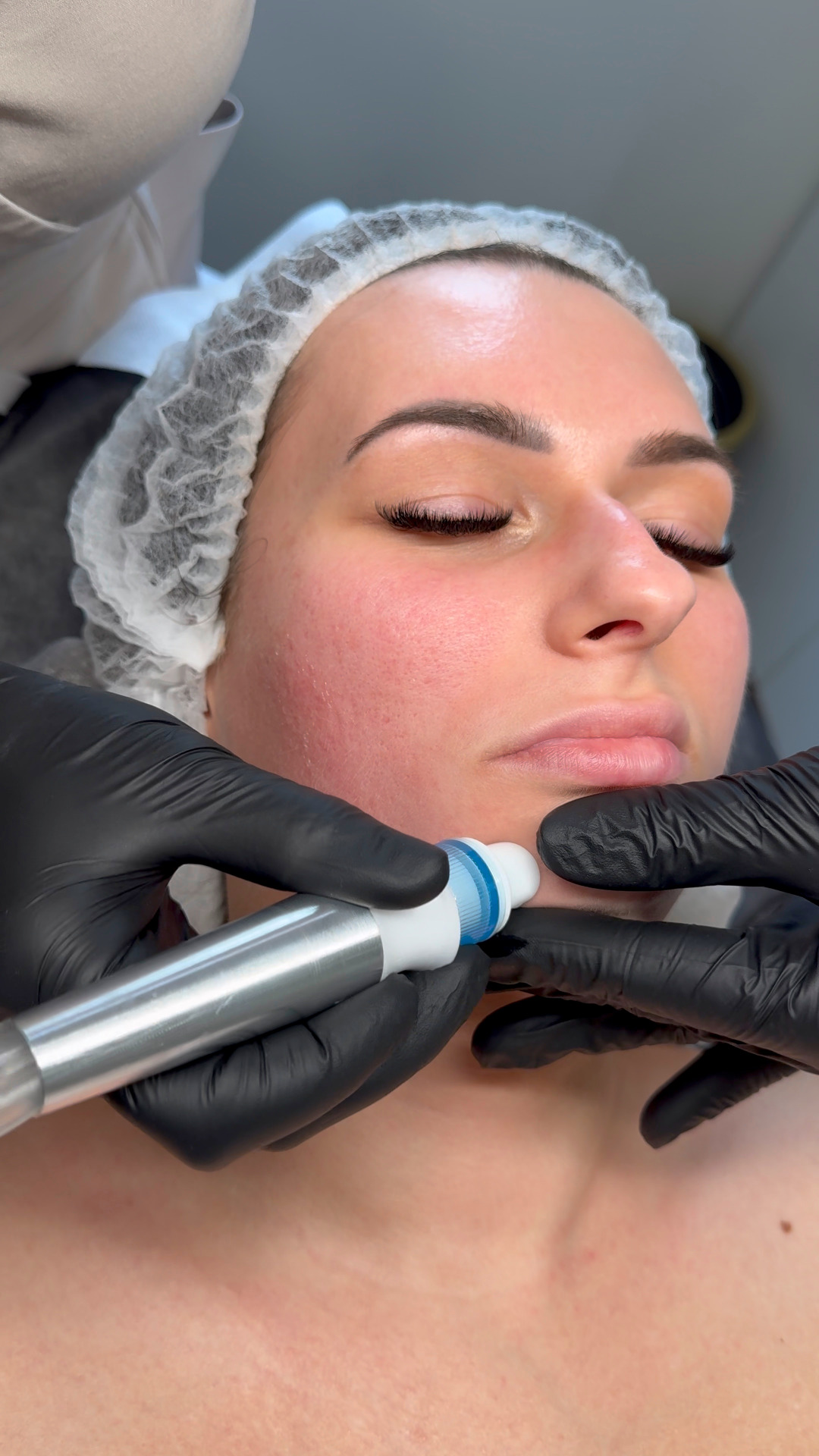 Oczyszczanie wodorowe i oxybrazja w Skin Story Rybnik